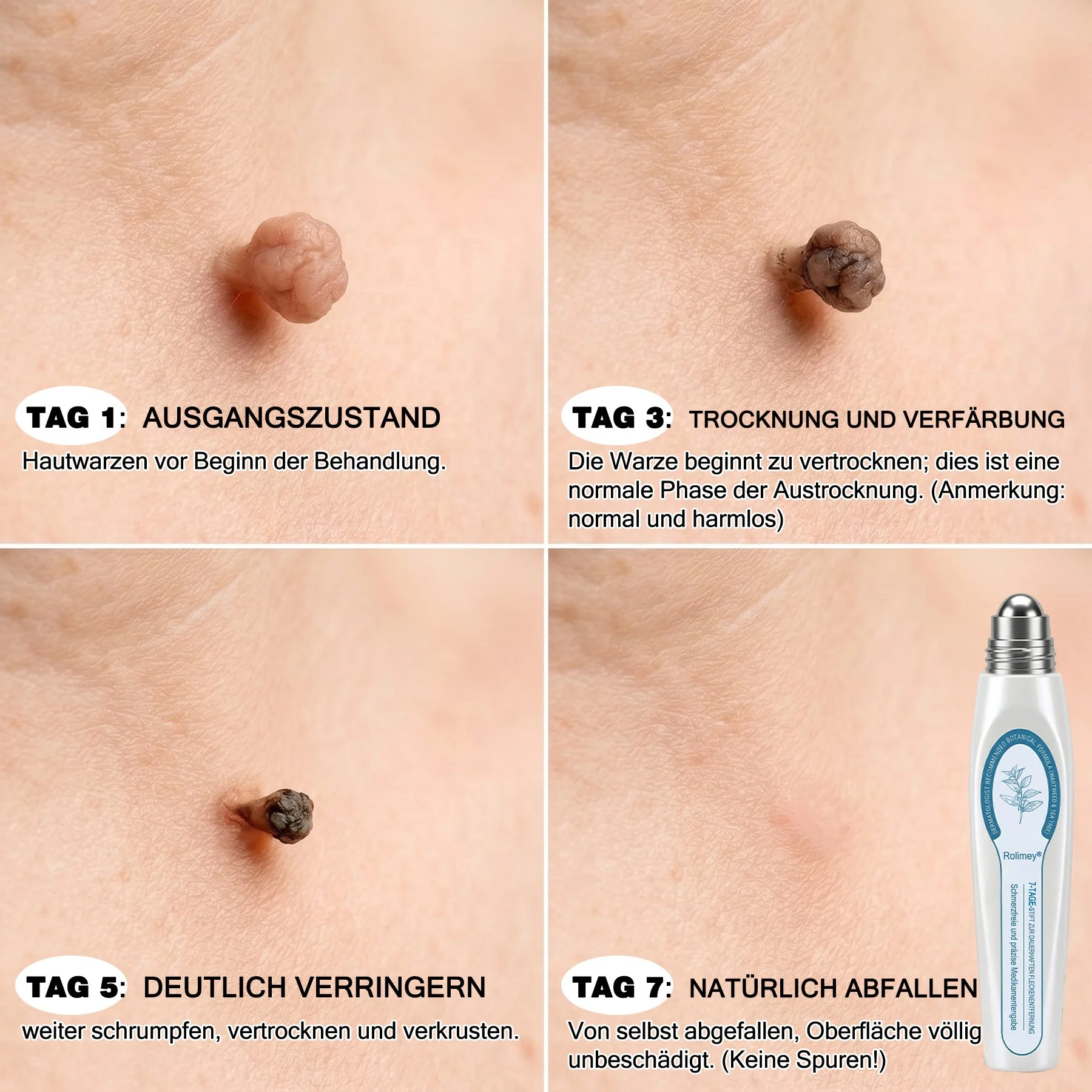 Rolimey® 7-Tage Tag- & Spot-Entferner🧬 (𝐙𝗲𝗿𝗼 𝐏𝗮𝗶𝗻, 𝐙𝗲𝗿𝗼 𝐒𝗰𝗮𝗿𝘀 Roll-On) ✅ Geeignet für: Hauttags, Flecken, Muttermale, Warzen, Blasen, Ekzeme, Schuppen, Hautkeratosen, Akne, Hautwucherungen, Narben, Geburtstagsmale 👩‍⚕️ - Image 3